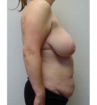 abdominal fascia before